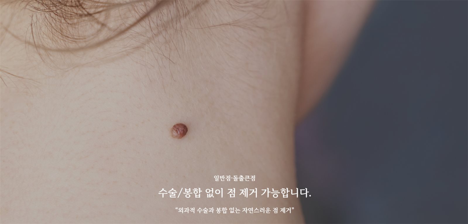 수술·봉합 없이 침으로 제거하는 일반점·돌출점